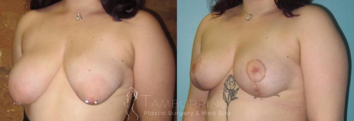 Before & After Breast Lift Case 16 Oblique #2 View in Doylestown, PA