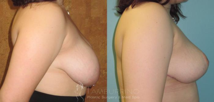 Before & After Breast Lift Case 16 Side #1 View in Doylestown, PA
