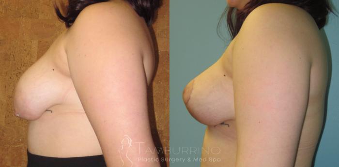 Before & After Breast Lift Case 16 Side #2 View in Doylestown, PA