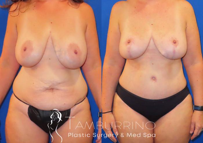 Before & After Breast Lift Case 30 Front View in Doylestown, PA