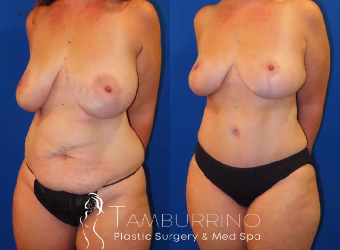 Before & After Breast Lift Case 30 Left Oblique View in Doylestown, PA