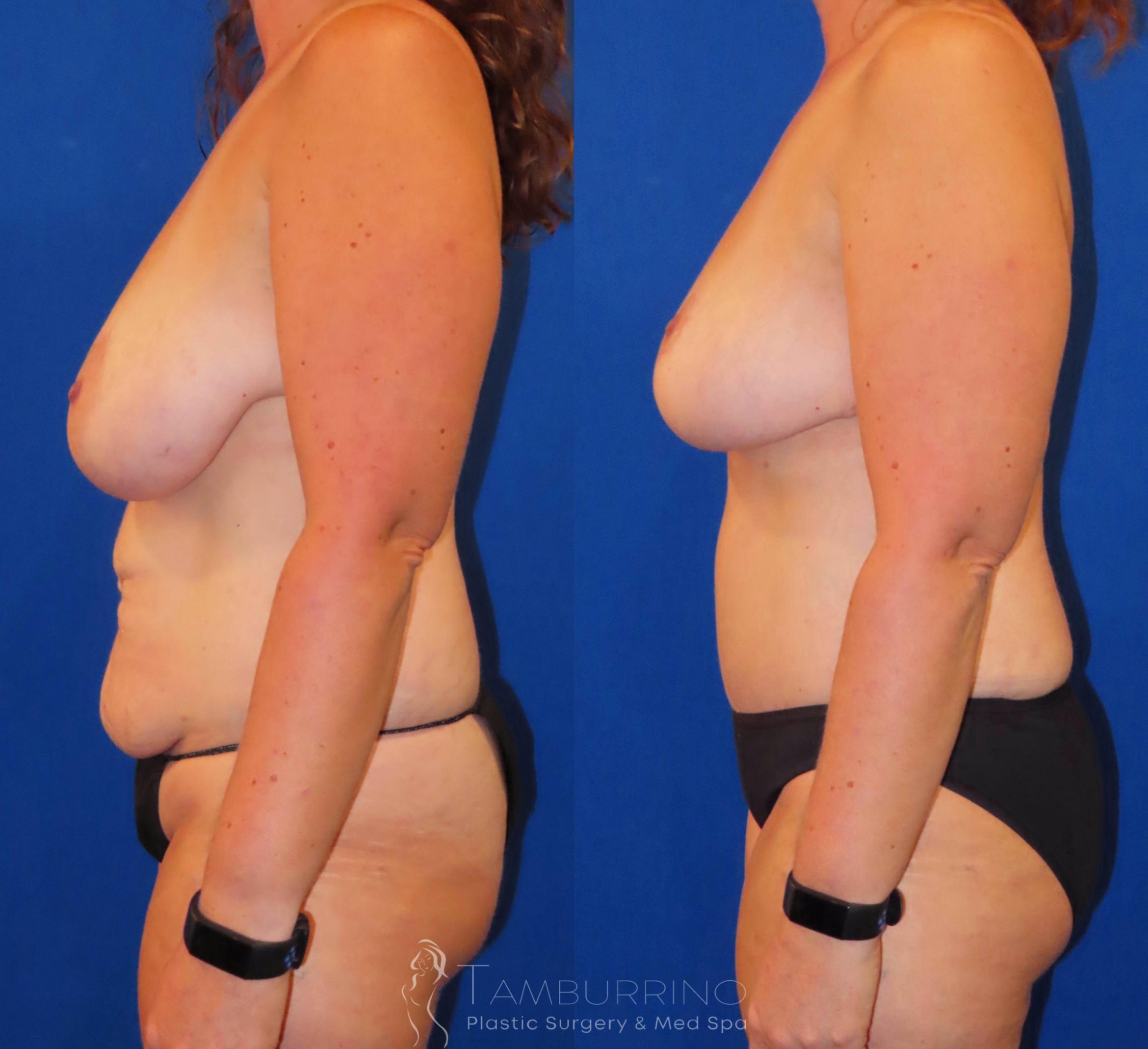 Before & After Breast Lift Case 30 Left Side View in Doylestown, PA