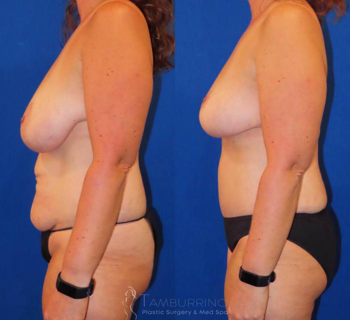 Before & After Breast Lift Case 30 Left Side View in Doylestown, PA