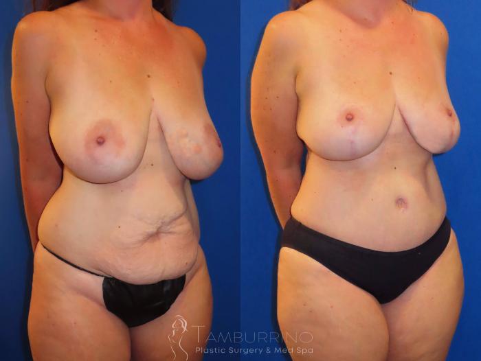 Before & After Breast Lift Case 30 Right Oblique View in Doylestown, PA
