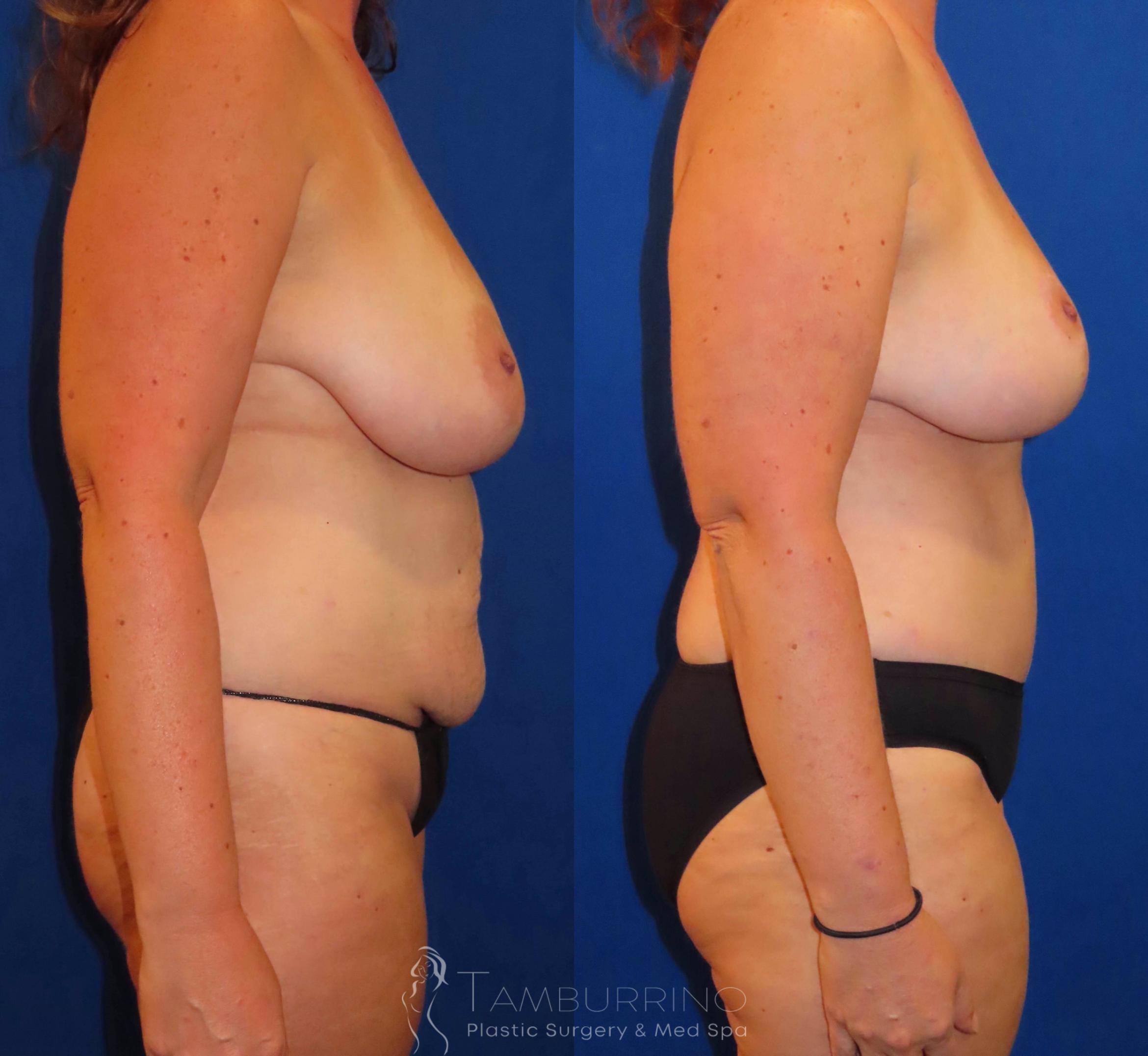 Before & After Breast Lift Case 30 Right Side View in Doylestown, PA