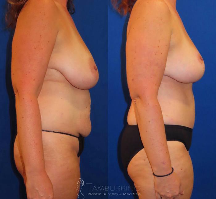 Before & After Breast Lift Case 30 Right Side View in Doylestown, PA