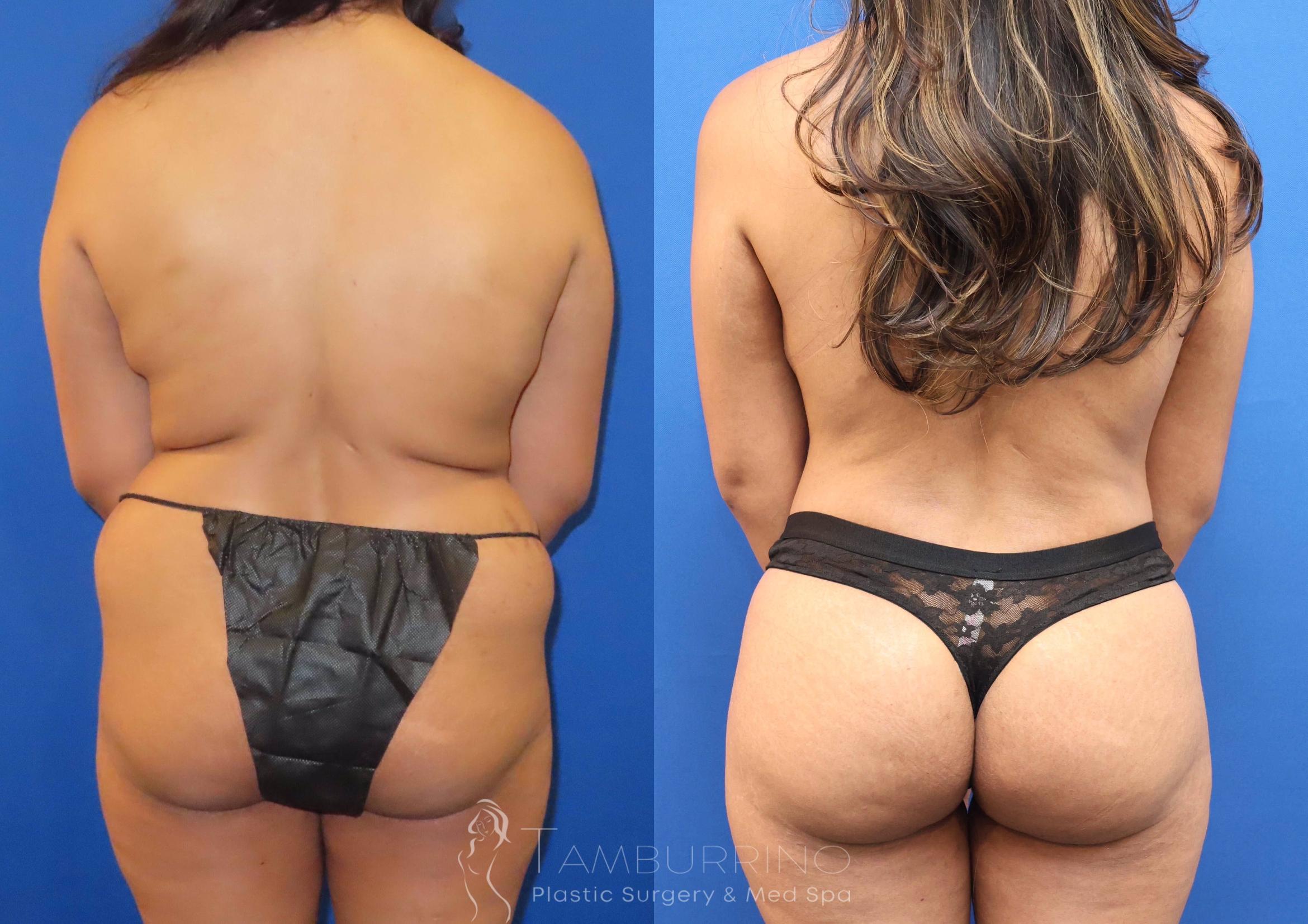 Before & After Breast Lift Case 69 Back View in Doylestown, PA