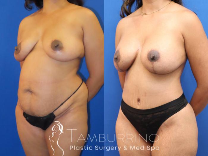Before & After Breast Lift Case 69 Left Oblique View in Doylestown, PA