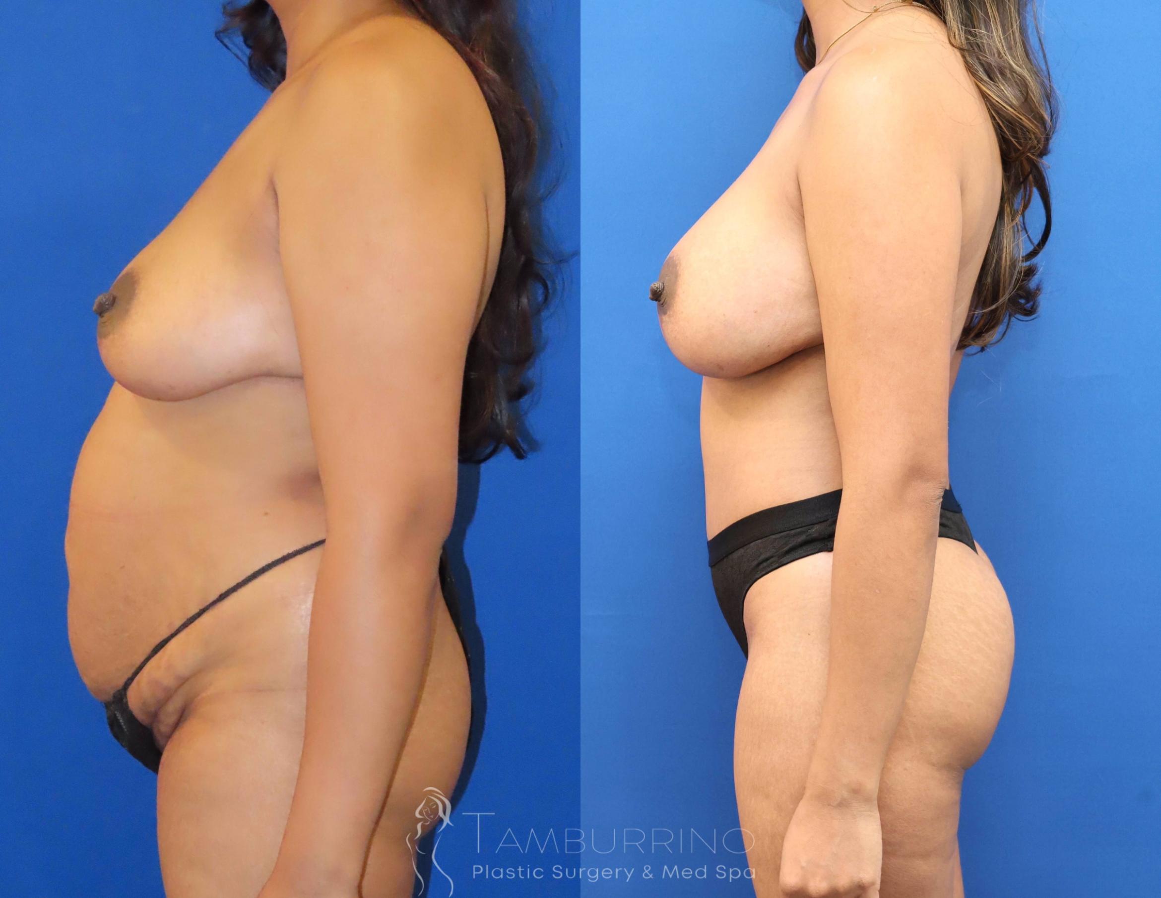 Before & After Breast Lift Case 69 Left Side View in Doylestown, PA