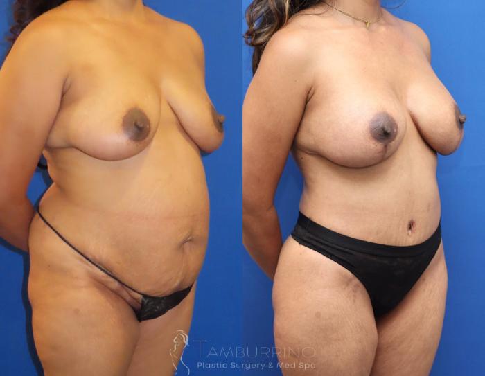 Before & After Breast Lift Case 69 Right Oblique View in Doylestown, PA