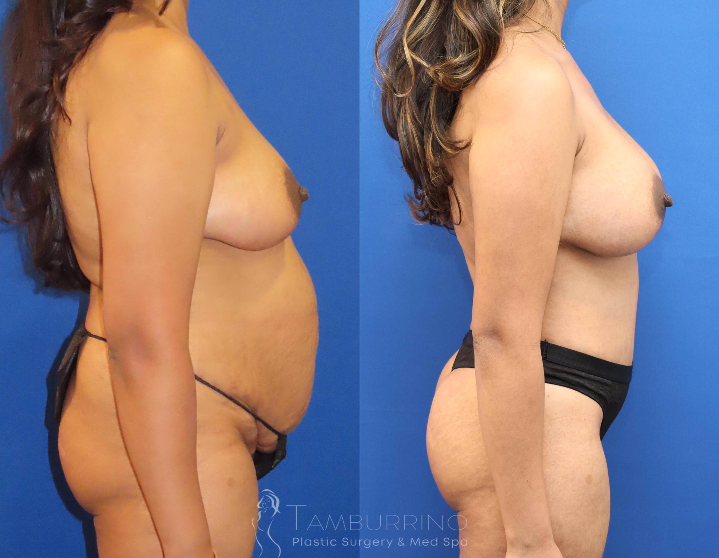 Before & After Breast Lift Case 69 Right Side View in Doylestown, PA