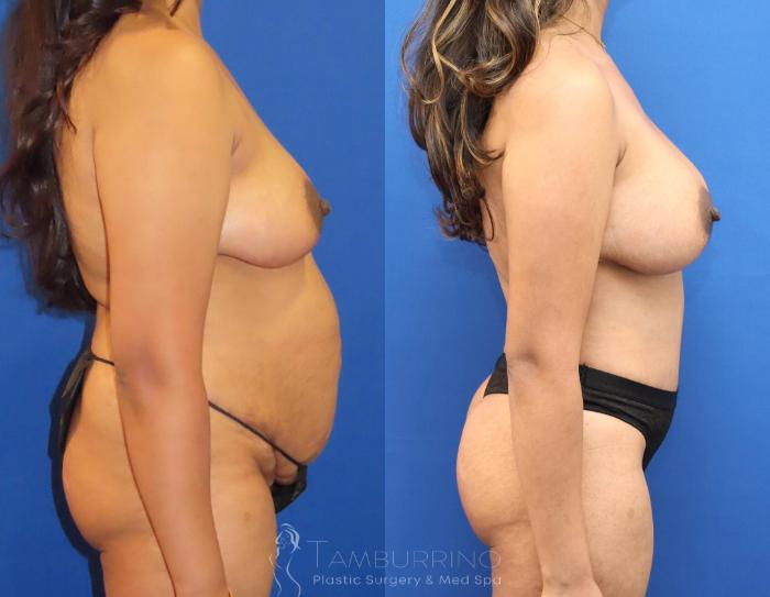 Before & After Breast Lift Case 69 Right Side View in Doylestown, PA