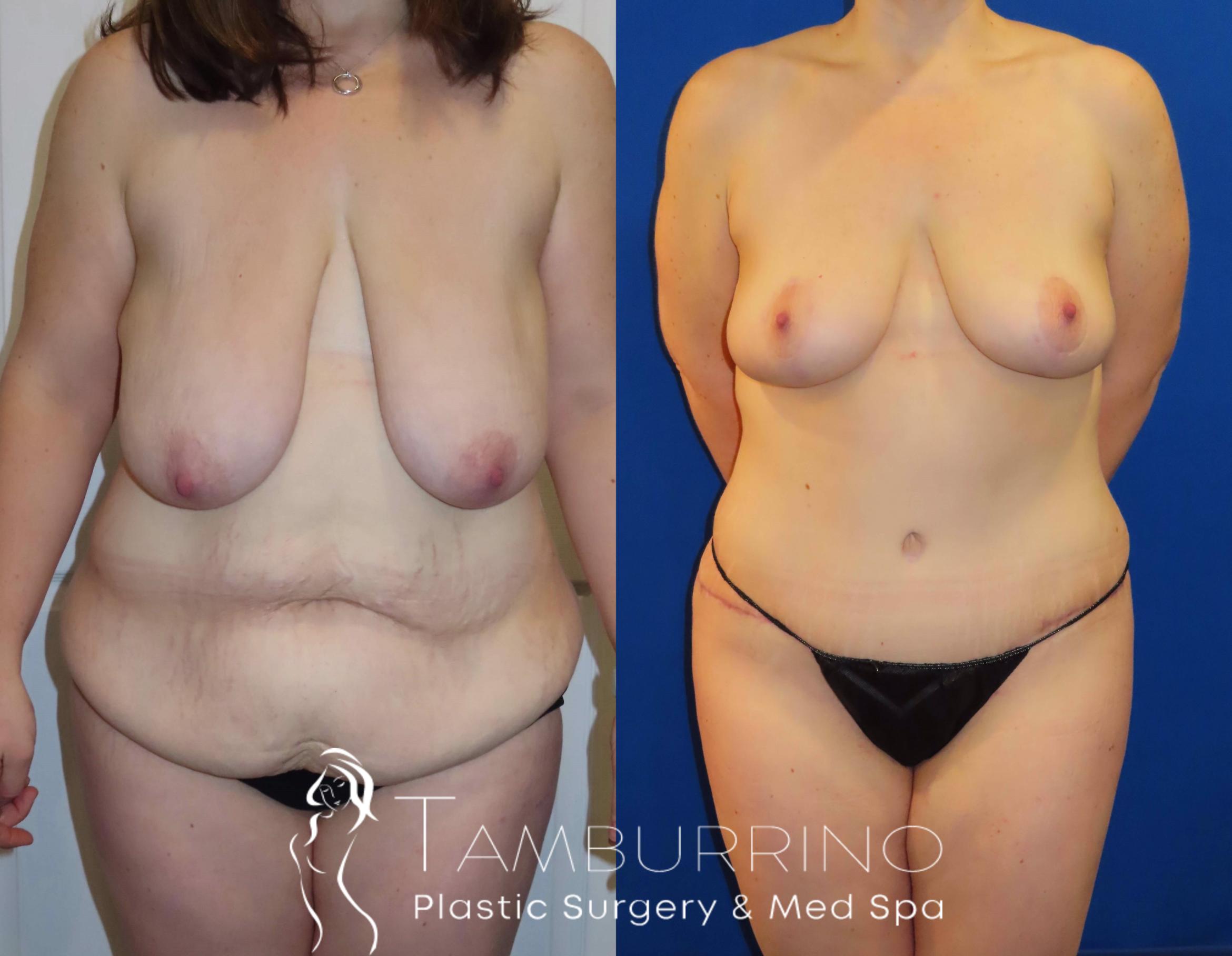 Before & After Breast Reduction Case 28 Frontal View in Doylestown, PA