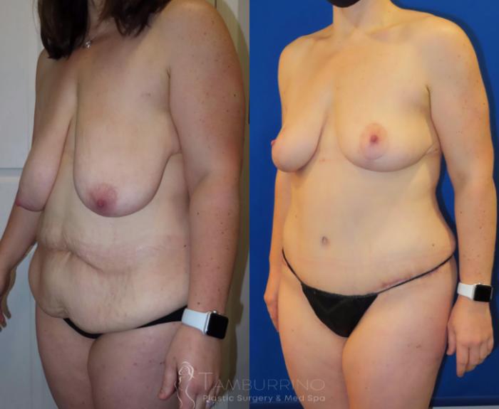 Before & After Breast Reduction Case 28 Left Oblique View in Doylestown, PA