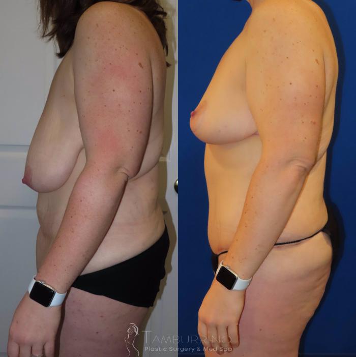Before & After Breast Reduction Case 28 Left Side View in Doylestown, PA