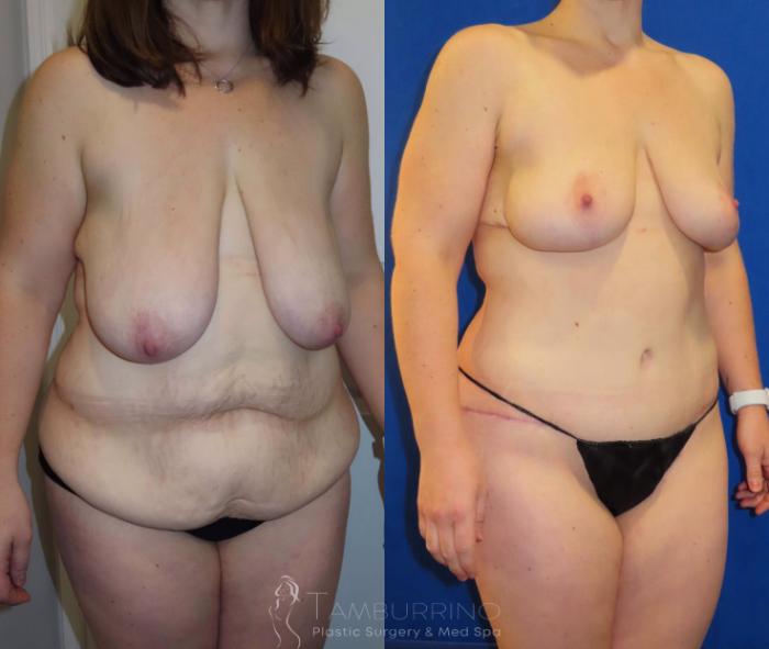Before & After Breast Reduction Case 28 Right Oblique View in Doylestown, PA