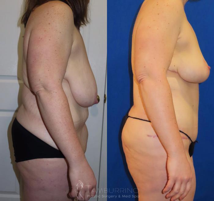 Before & After Breast Reduction Case 28 Right Side View in Doylestown, PA