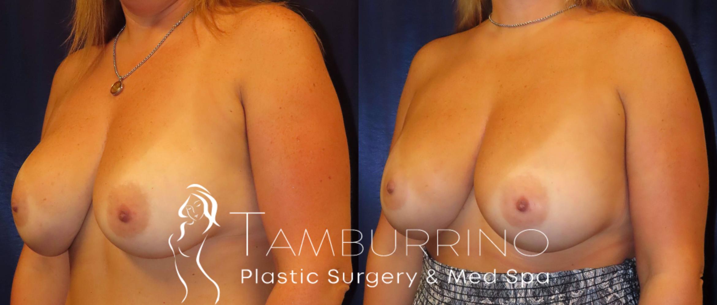 Before & After Breast Revision Case 10 Oblique View in Doylestown, PA