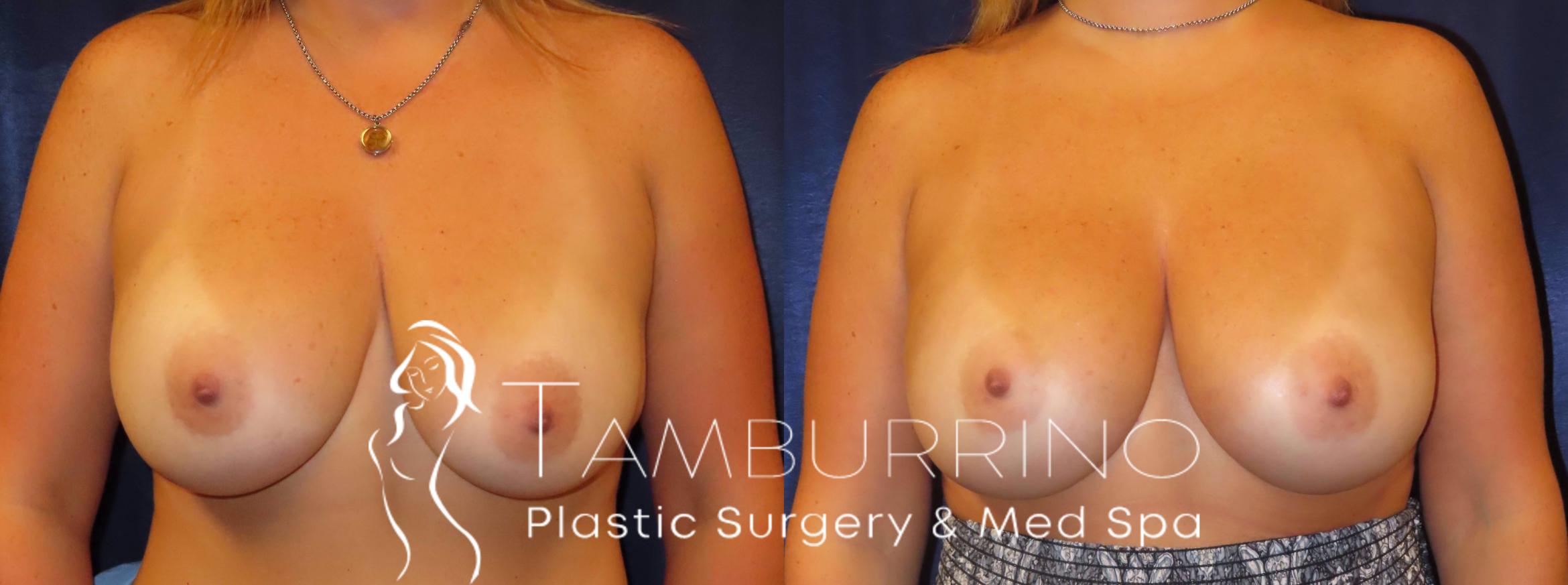 Before & After Breast Revision Case 10 Revision Breast Augmentation View in Doylestown, PA