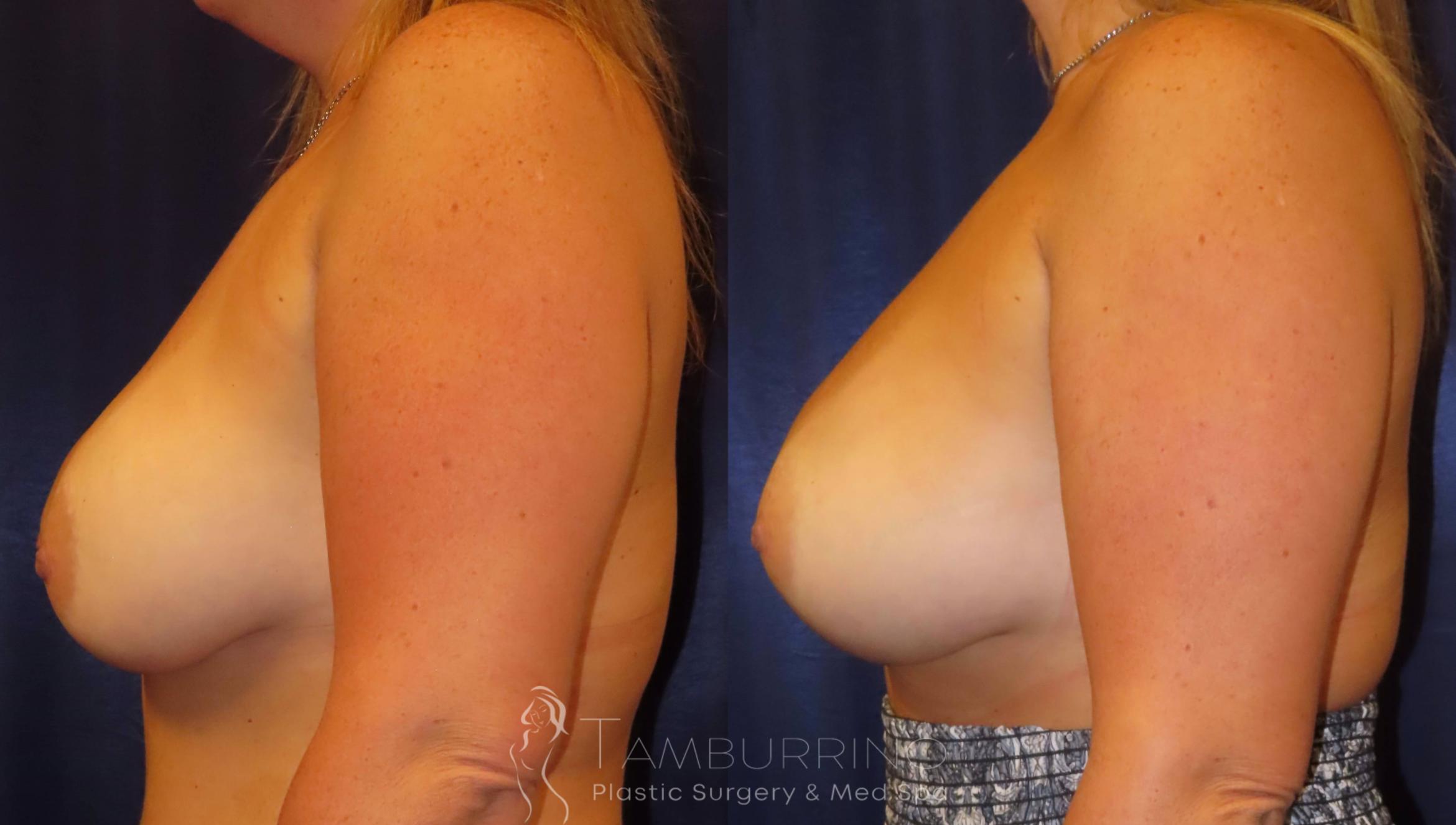 Before & After Breast Revision Case 10 Side View in Doylestown, PA