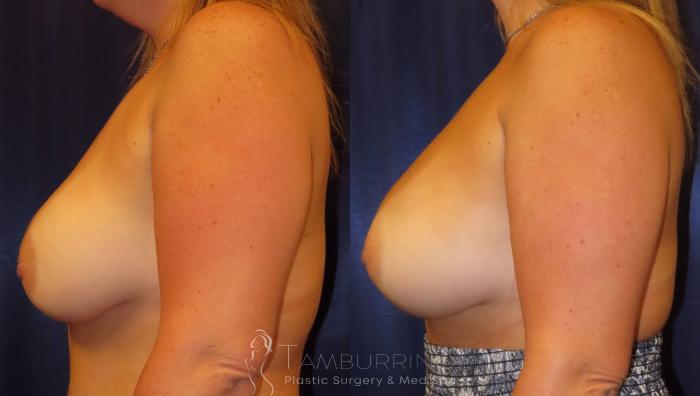 Before & After Breast Revision Case 10 Side View in Doylestown, PA