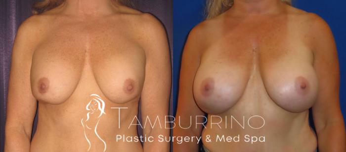 Before & After Breast Revision Case 6 Frontal View in Doylestown, PA