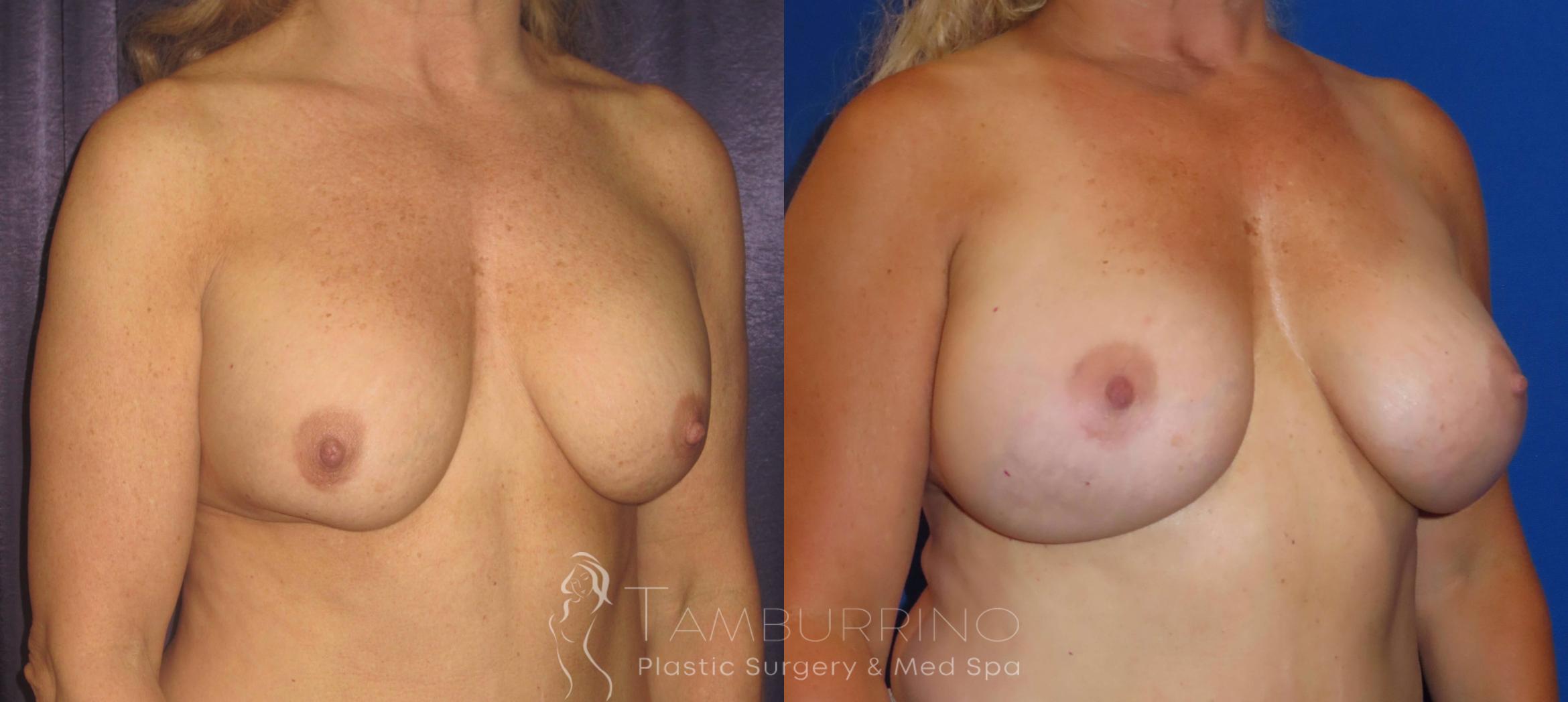 Before & After Breast Revision Case 6 Oblique View in Doylestown, PA