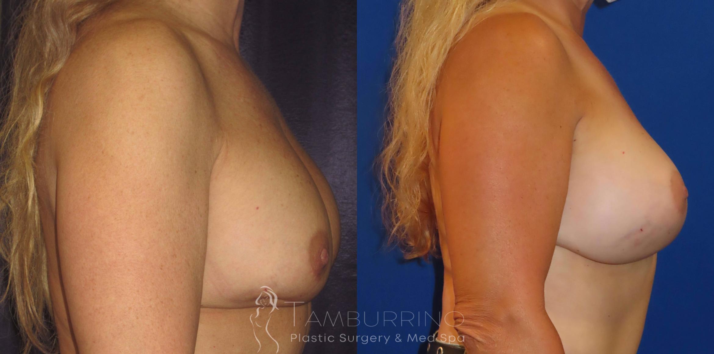 Before & After Breast Revision Case 6 Side View in Doylestown, PA