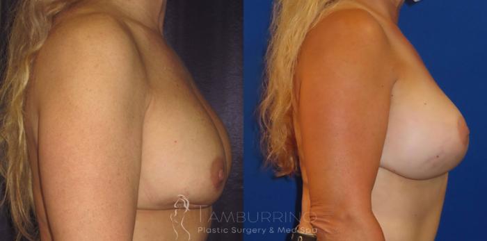 Before & After Breast Revision Case 6 Side View in Doylestown, PA
