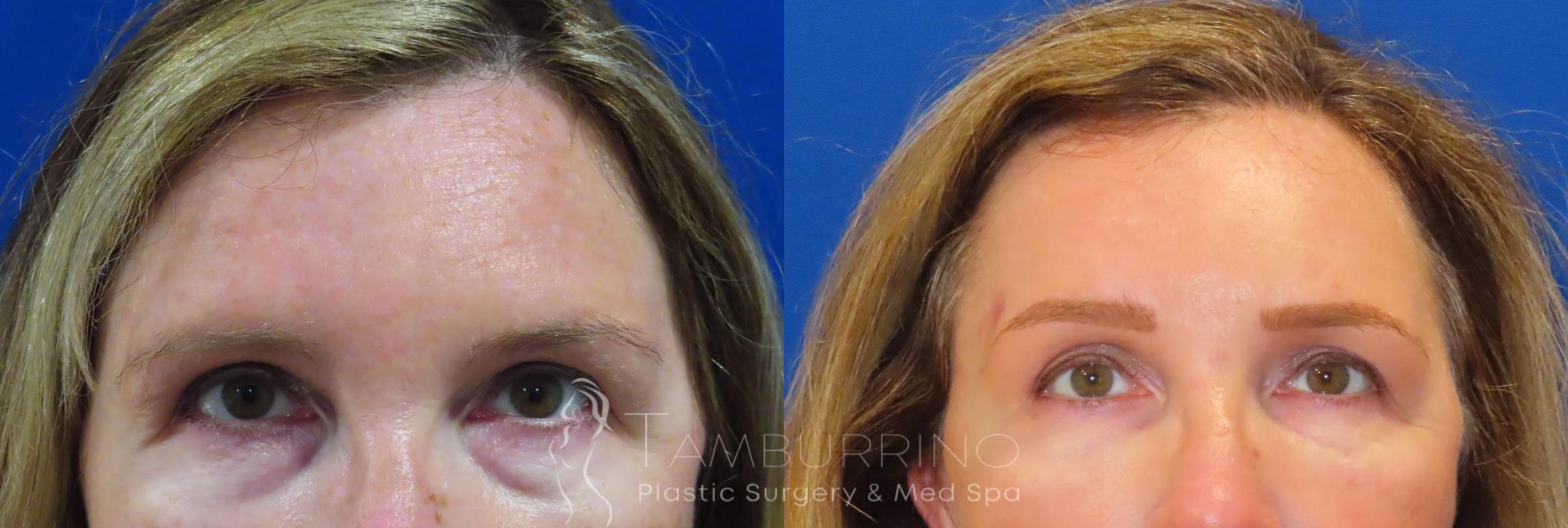 Before & After Brow Lift Case 39 Endoscopic Brow Lift & Filler View in Doylestown, PA