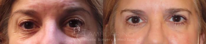 Before & After Eyelid Lift Case 46 Frontal View in Doylestown, PA