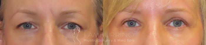 Before & After Eyelid Lift Case 50 Frontal View in Doylestown, PA
