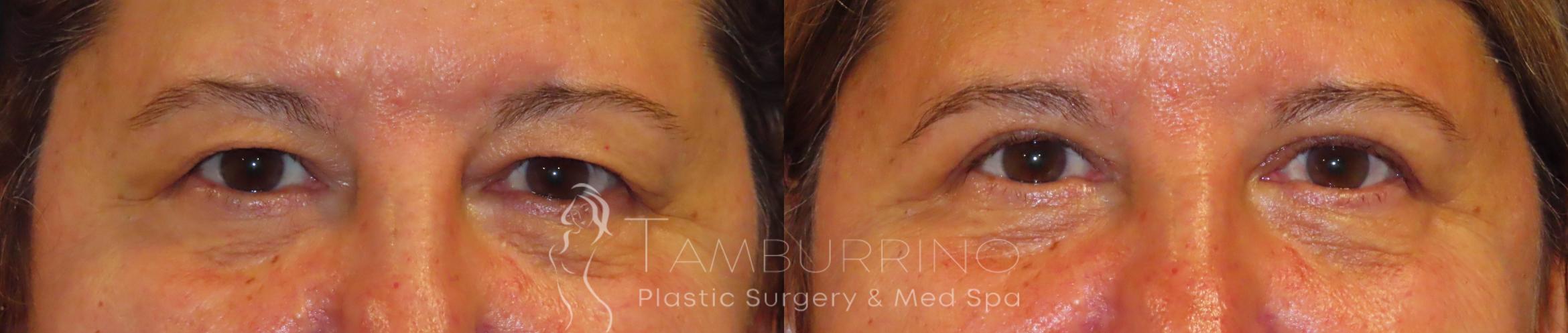 Before & After Eyelid Lift Case 51 Frontal View in Doylestown, PA
