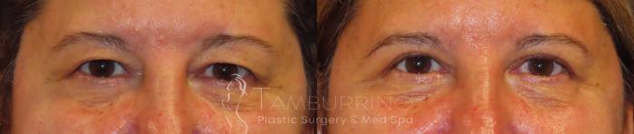 Before & After Eyelid Lift Case 51 Frontal View in Doylestown, PA