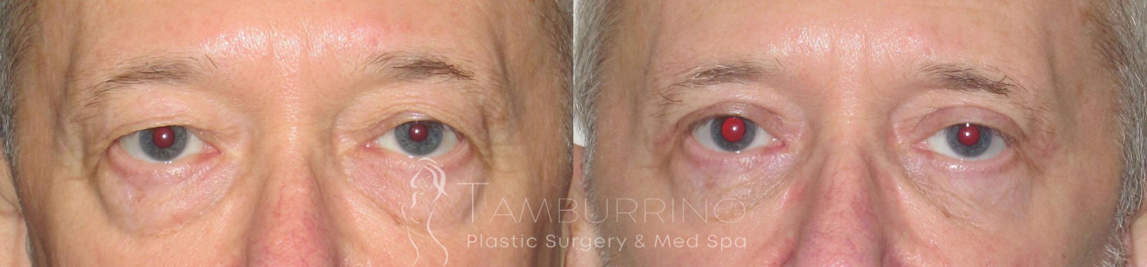 Before & After Eyelid Lift Case 54 Frontal View in Doylestown, PA