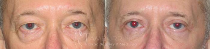 Before & After Eyelid Lift Case 54 Frontal View in Doylestown, PA