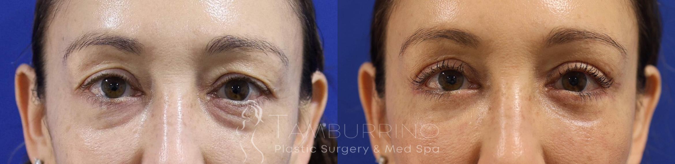 Before & After Eyelid Lift Case 72 Close Up View in Doylestown, PA