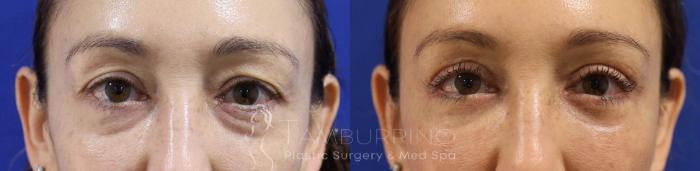 Before & After Eyelid Lift Case 72 Close Up View in Doylestown, PA