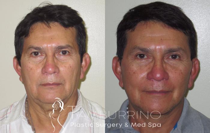 Before & After Neck Lift Case 20 Frontal View in Doylestown, PA