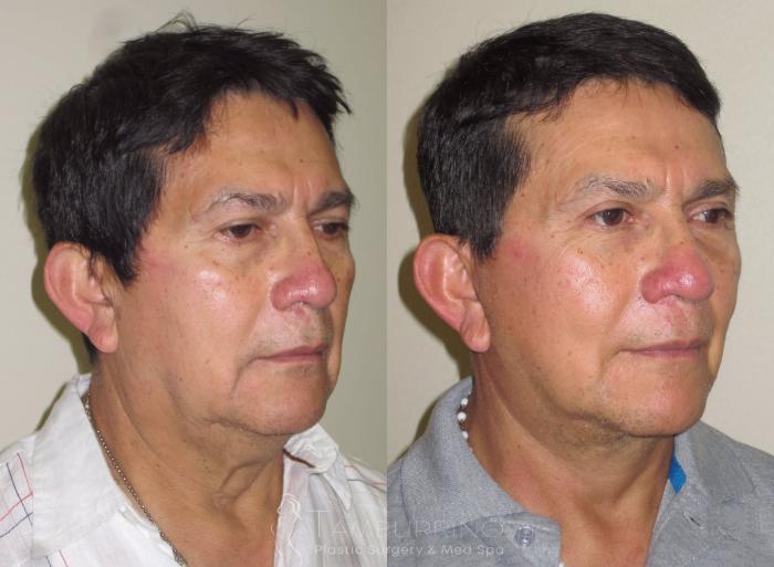 Before & After Facelift Case 20 Oblique #1 View in Doylestown, PA