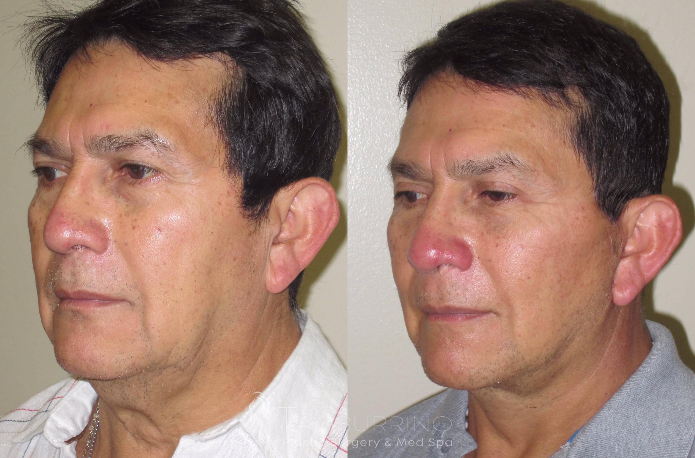 Before & After Facelift Case 20 Oblique #2 View in Doylestown, PA