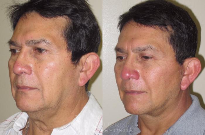 Before & After Facelift Case 20 Oblique #2 View in Doylestown, PA