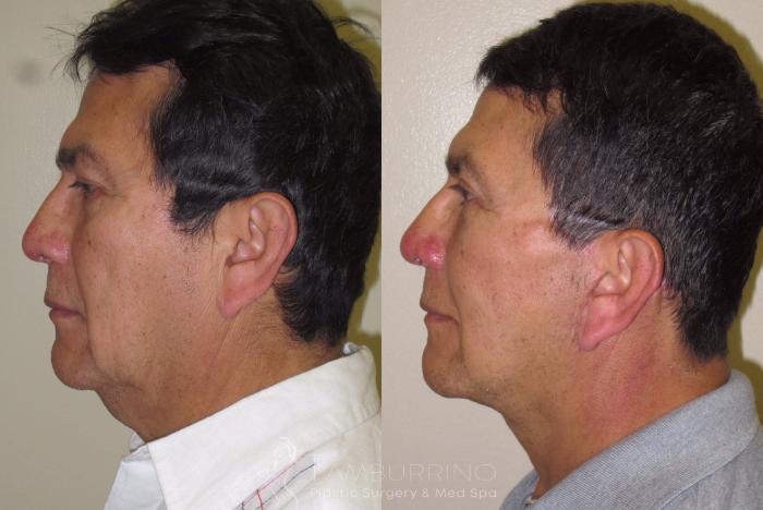 Before & After Facelift Case 20 Side #1 View in Doylestown, PA