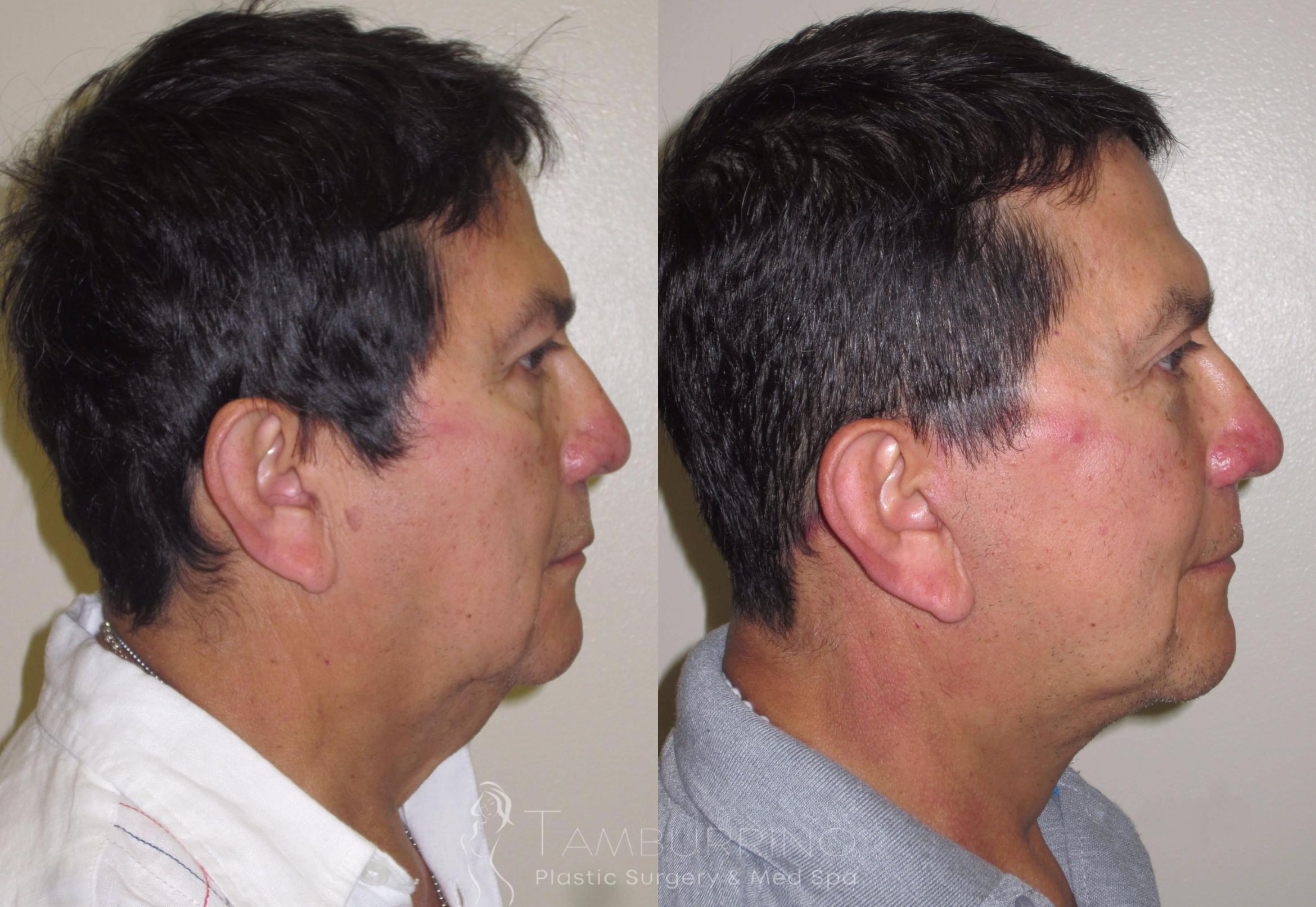 Before & After Facelift Case 20 Side #2 View in Doylestown, PA