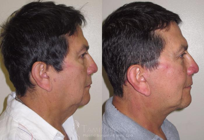 Before & After Facelift Case 20 Side #2 View in Doylestown, PA