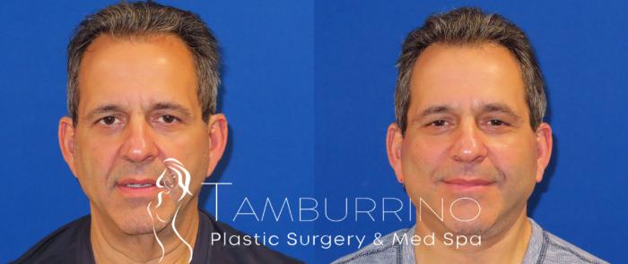 Before & After Neck Lift Case 24 Frontal View in Doylestown, PA