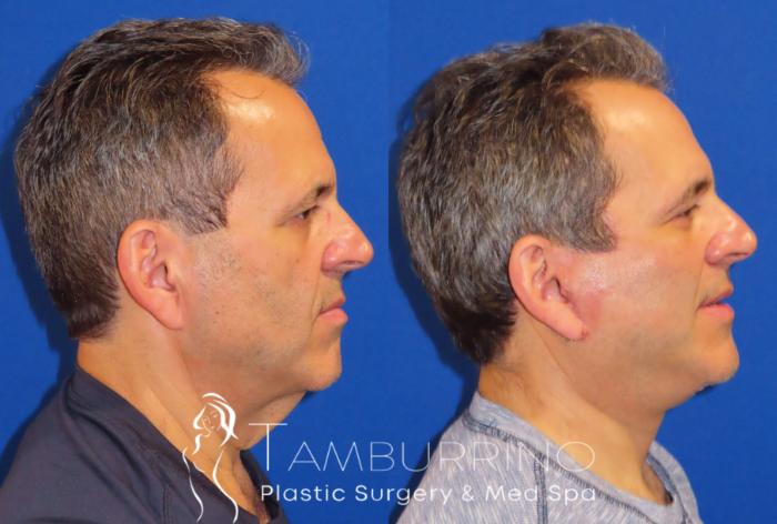 Before & After Facelift Case 24 Lateral #1 View in Doylestown, PA