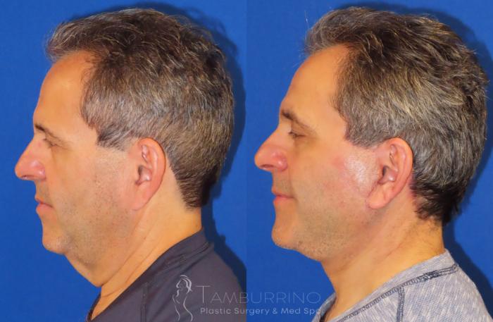 Before & After Facelift Case 24 Lateral #2 View in Doylestown, PA
