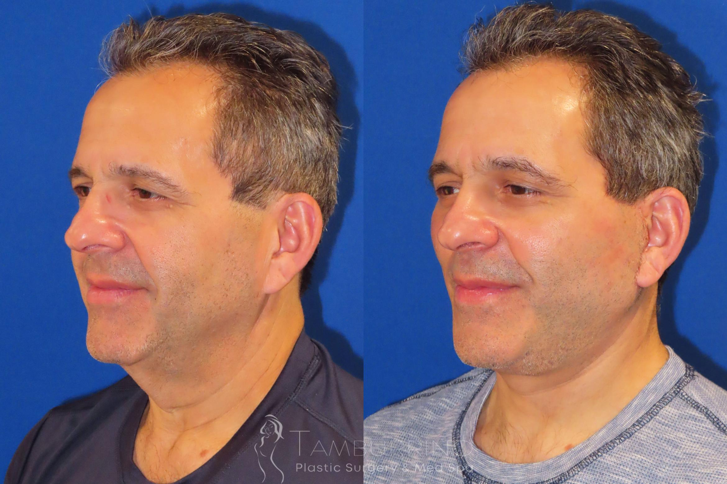 Before & After Facelift Case 24 Oblique #1 View in Doylestown, PA