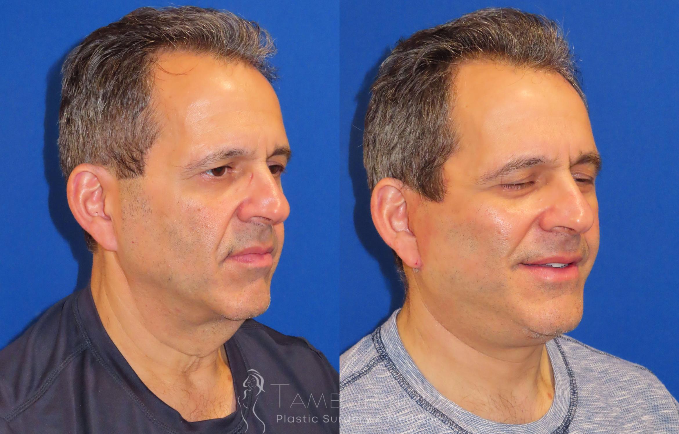 Before & After Facelift Case 24 Oblique #2 View in Doylestown, PA